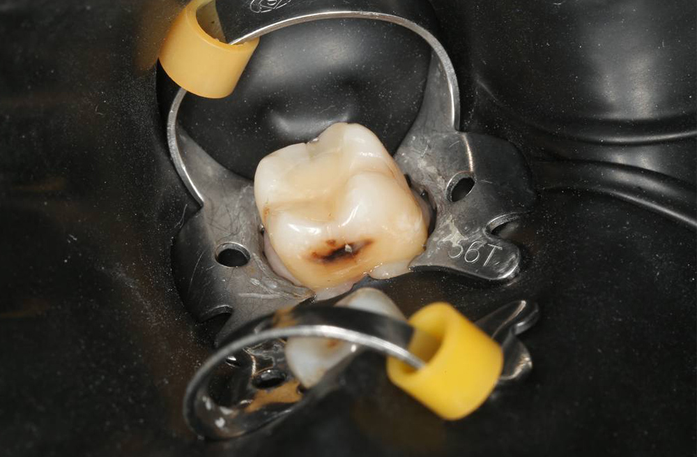 Устранение кариеса на боковом пункте моляра с послойным моделированием и полировкой пломбы