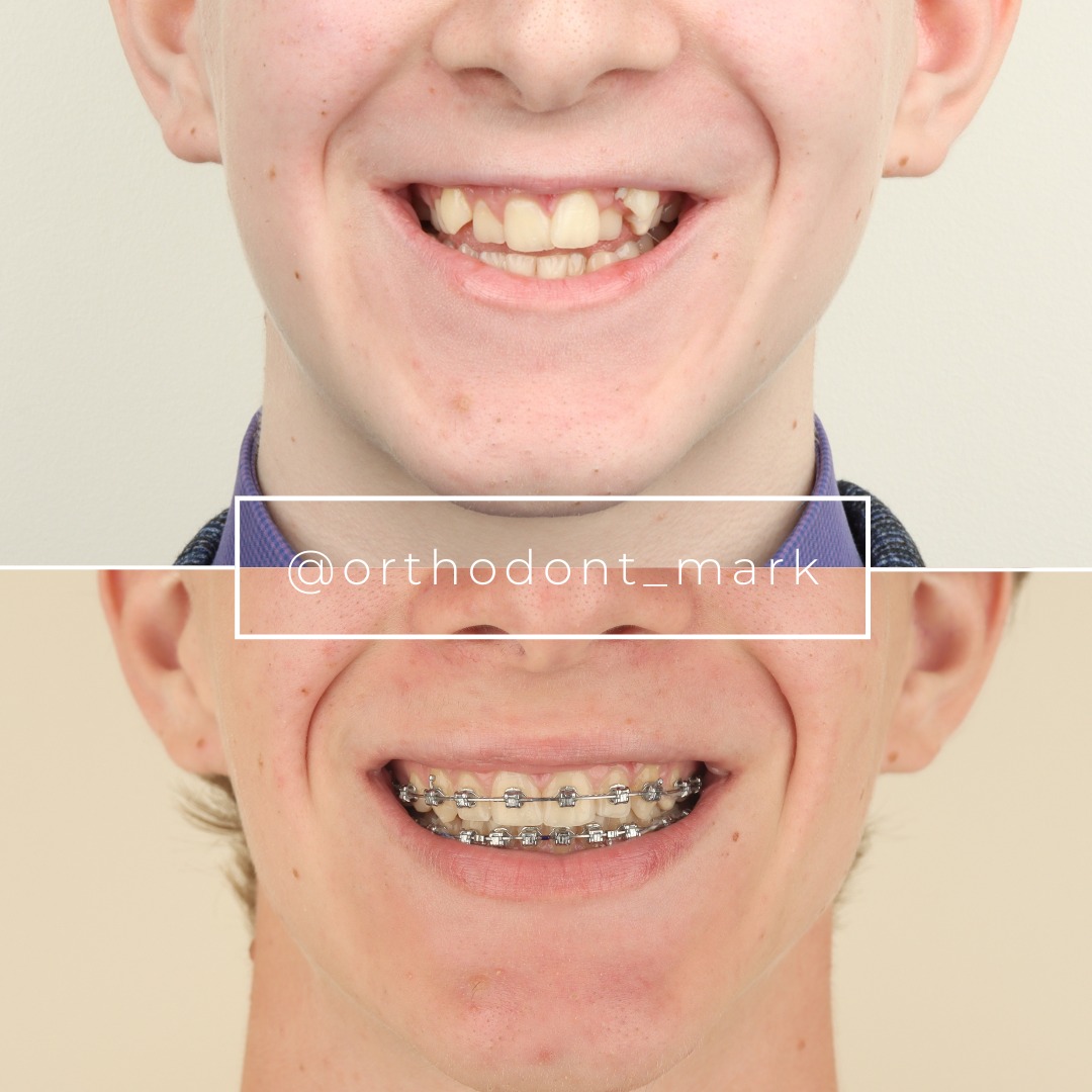 Correcting Severe Space Deficit With MARPE and Molar Distalization