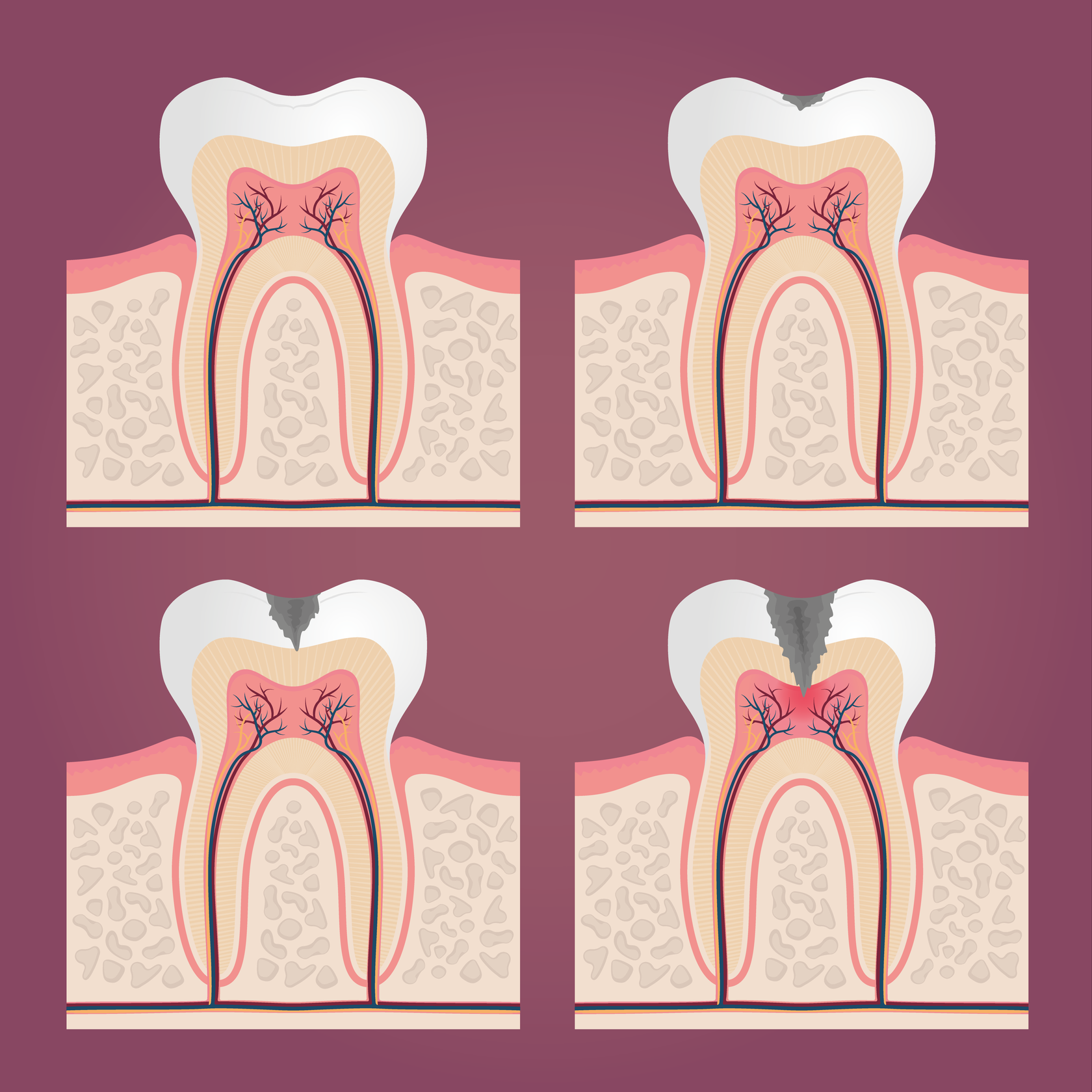 Лечение кариеса в клинике доктора Малиновской «Dentsy»