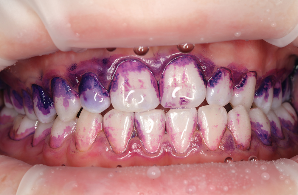 Удаление мягкого и пигментированного налёта у подростка с использованием Air-flow