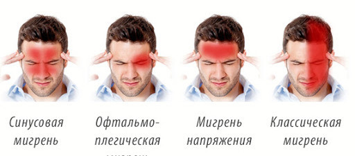 Типы мигрени