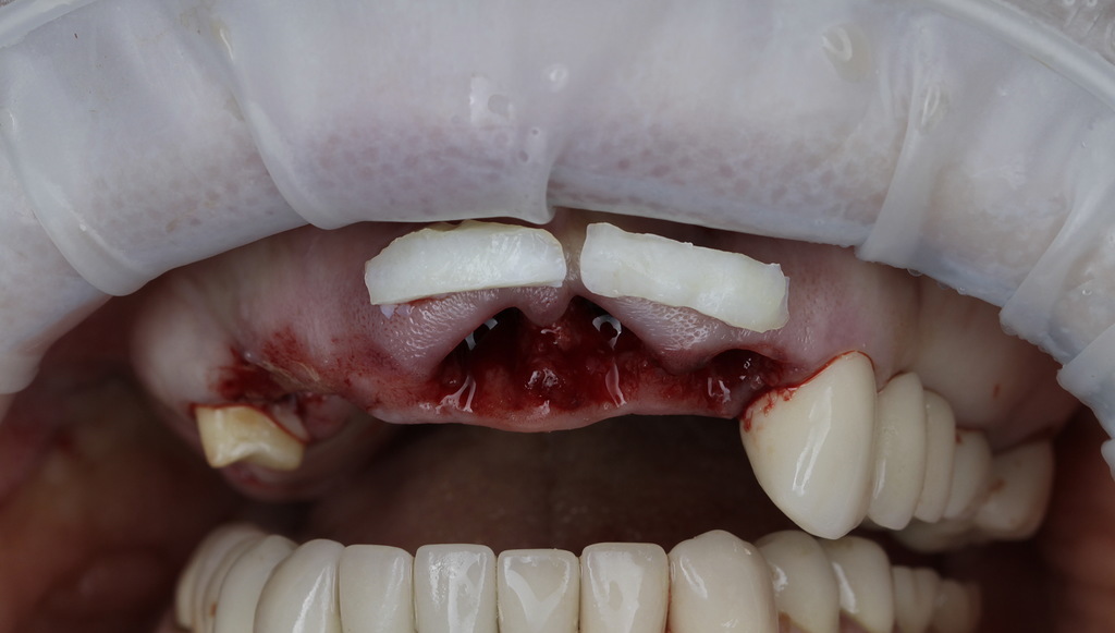 Вид после удаления зубов. Получены мягкотканые трансплантаты из области бугров верхней челюсти