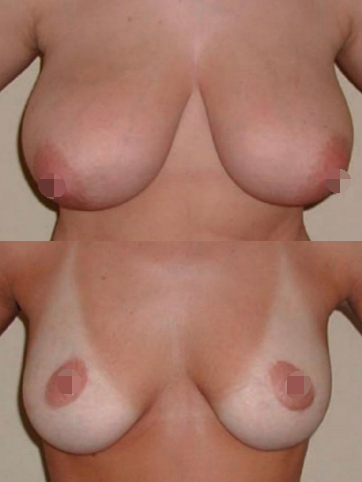 уменьшение груди у женщин фото 14
