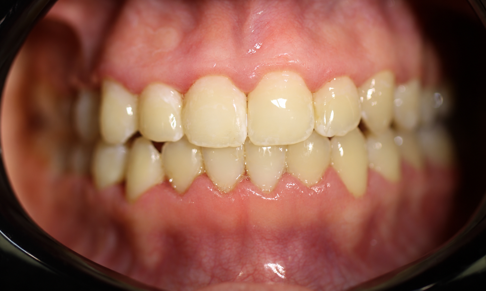 Фронтальный вид после лечения на элайнерах Star Smile