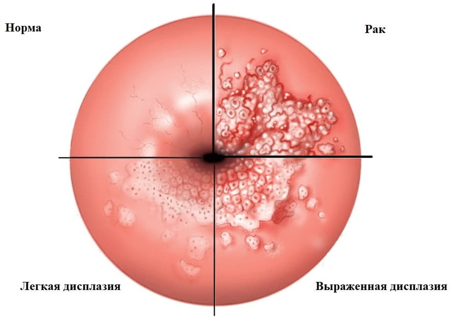 Цин матки. Дисплазия шейки кольпоскопия. Псевдоэрозия шейки матки. Дисплазия шейки матки кольпоскопия.