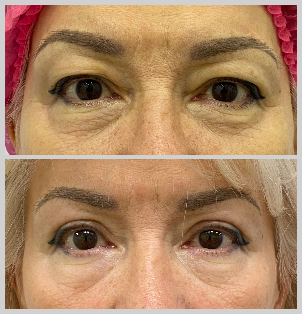 блефаропластика нависшие веки