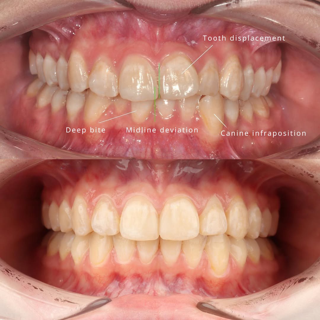 After treatment view showing a wide, open, symmetrical smile — photo 2 of 2