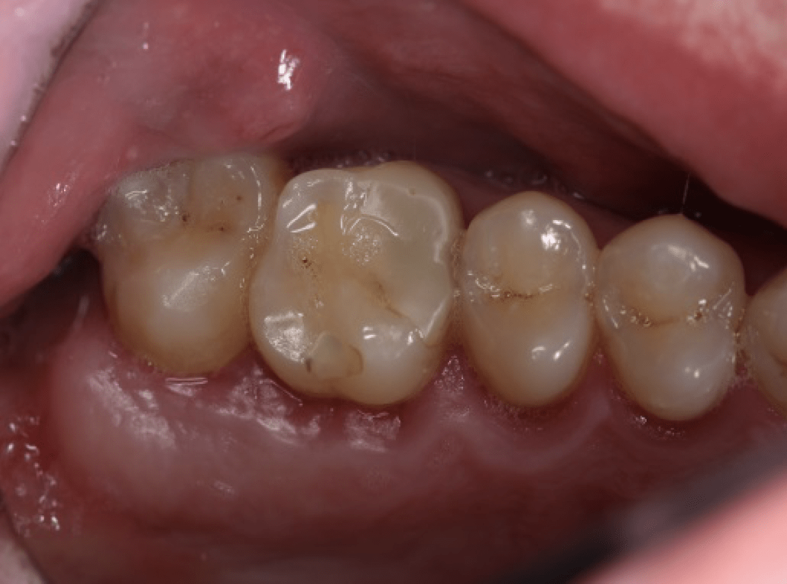 Лечение кариеса зуба - стоматология на Мичуринском проспекте