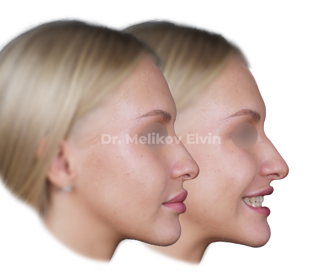 Фотографии после ортогнатической операции.