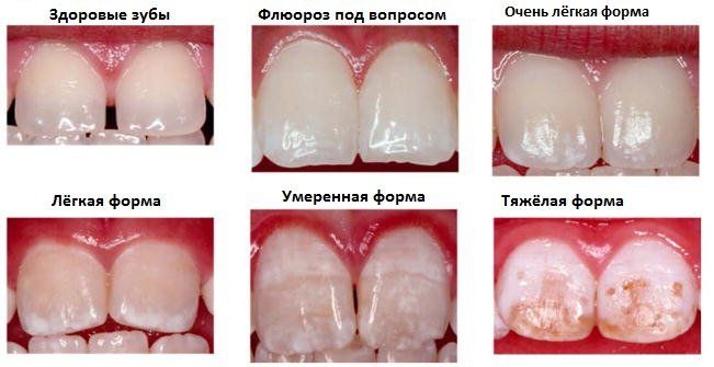 Анатомия временных зубов разных типов
