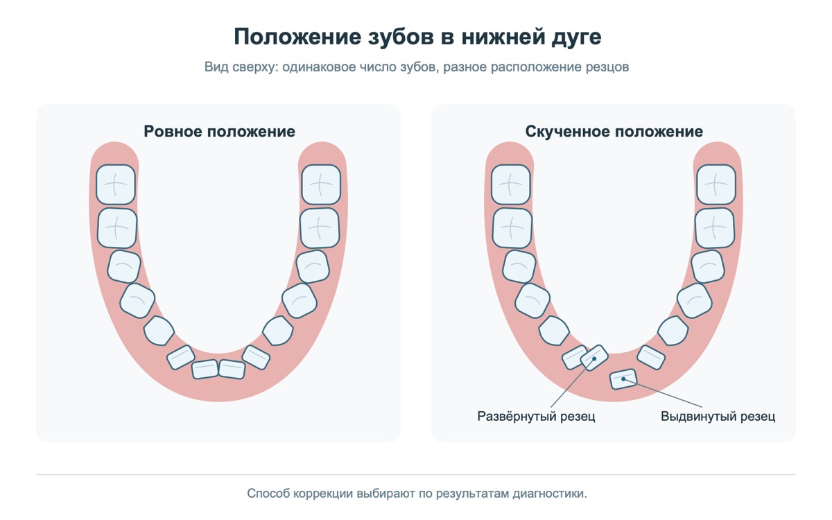 Сравнение ровного и скученного положения зубов