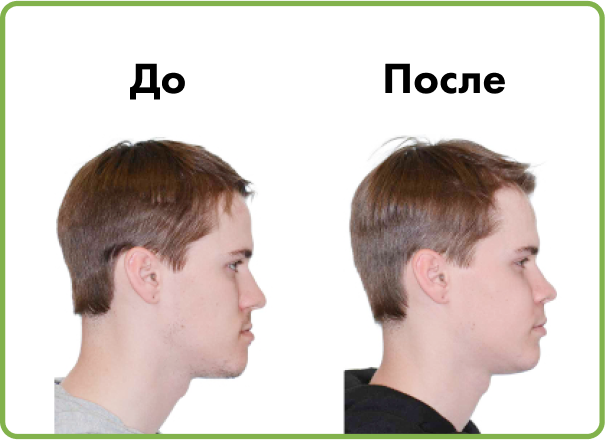 Установка имплантов в Дербенте. Имплантация при отсутствии одного зуба.