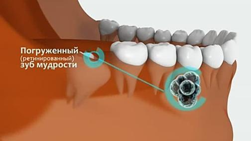 Симптомы прорезывания зуба мудрости фото