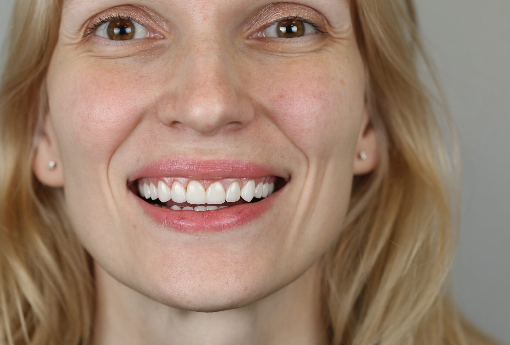 Результат установки керамических виниров для идеальной улыбки в Москве