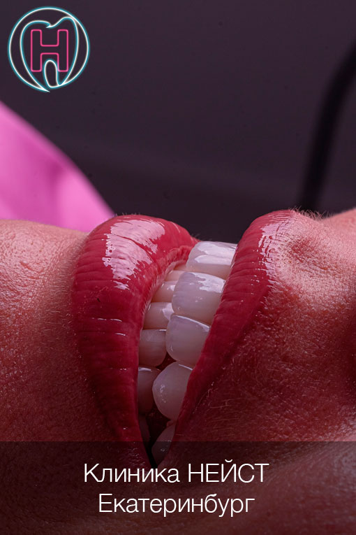 керамические виниры Премиум цвет Блич 2 (Bleach2)