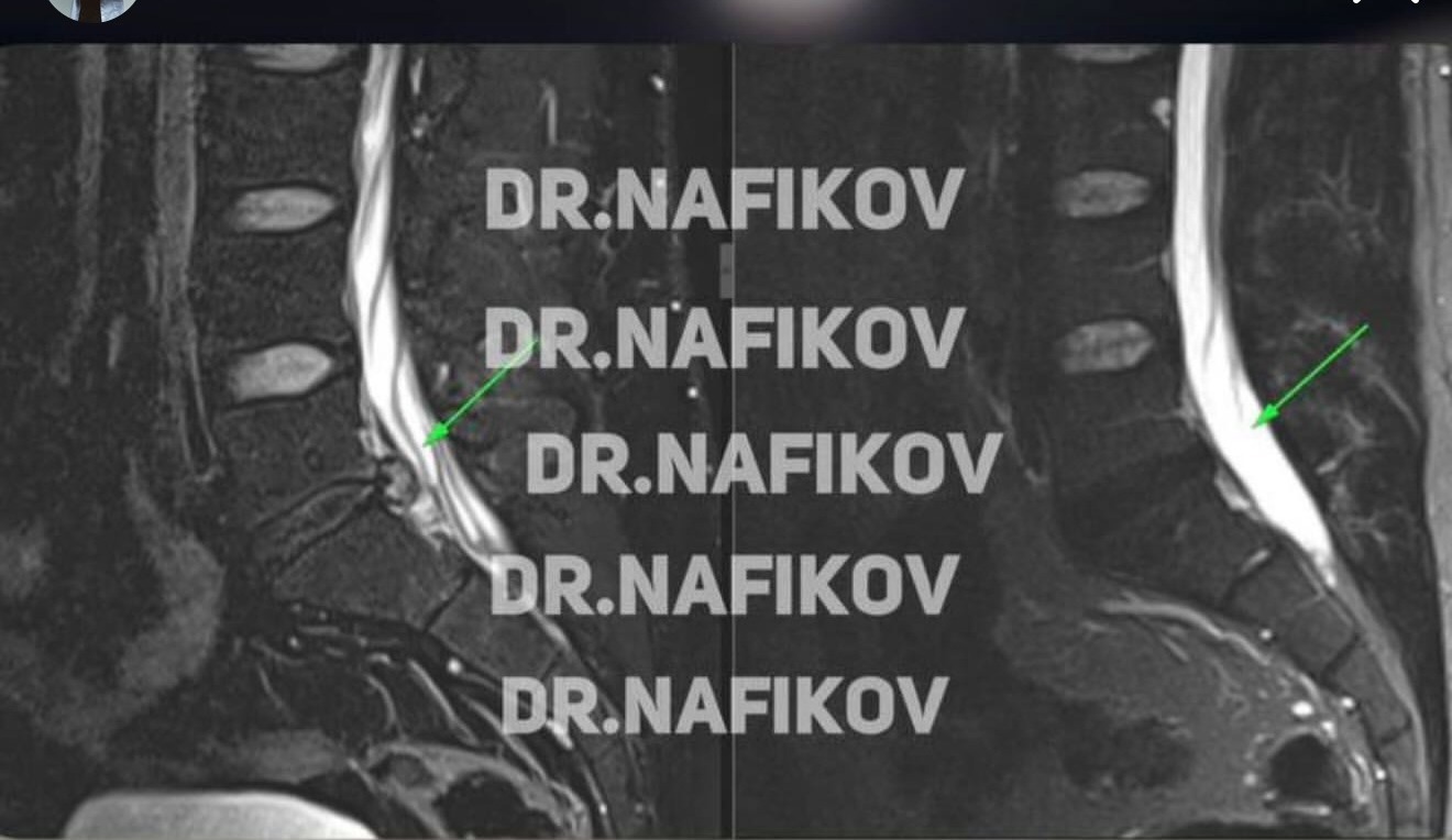 МРТ до и после лечения, Пациент А., 33 года