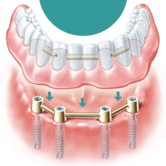 Имплантация челюсти на 4 имплантах