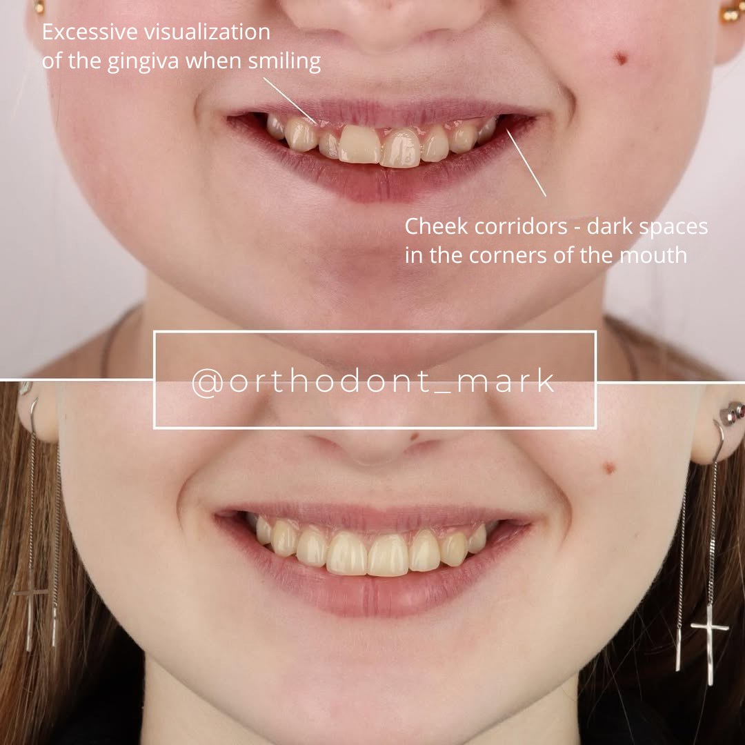 After treatment: wide, symmetrical smile with reduced cheek corridor darkness — photo 3 of 3