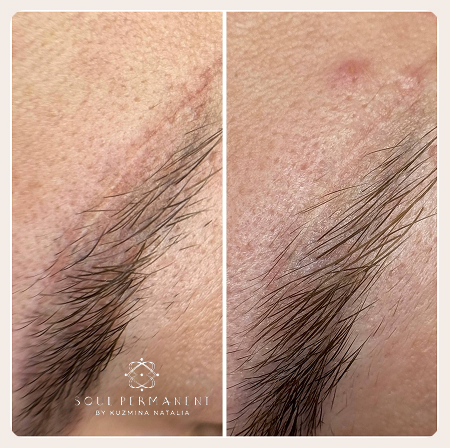 Удаление шрама после микроблейдинга в москве