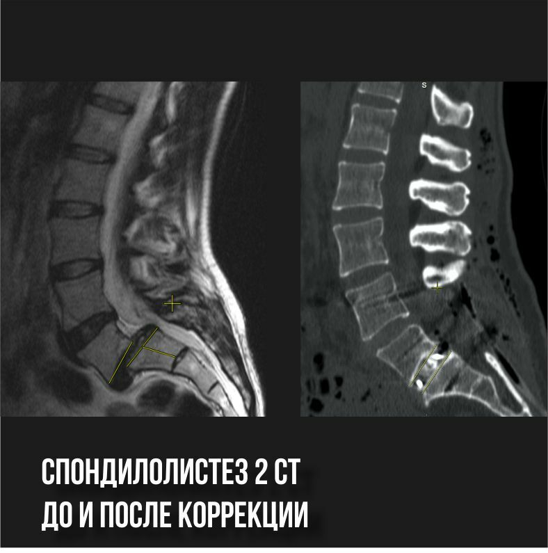 Антеспондилолистез позвоночника поясничного отдела. Смещение l5 позвонка кпереди. Спондилолистез l4 позвонка рентген. Спондилолистез l4 позвонка что это такое. Спондилолистез l5 s1.