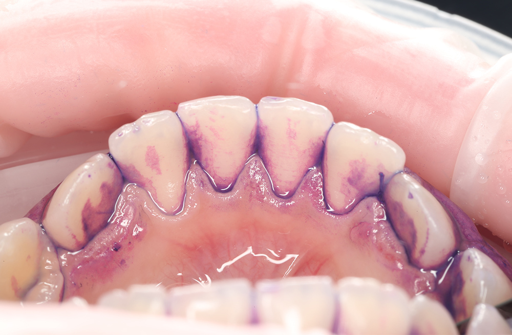 Детская чистка зубов с профессиональным уходом ребёнку 10 лет