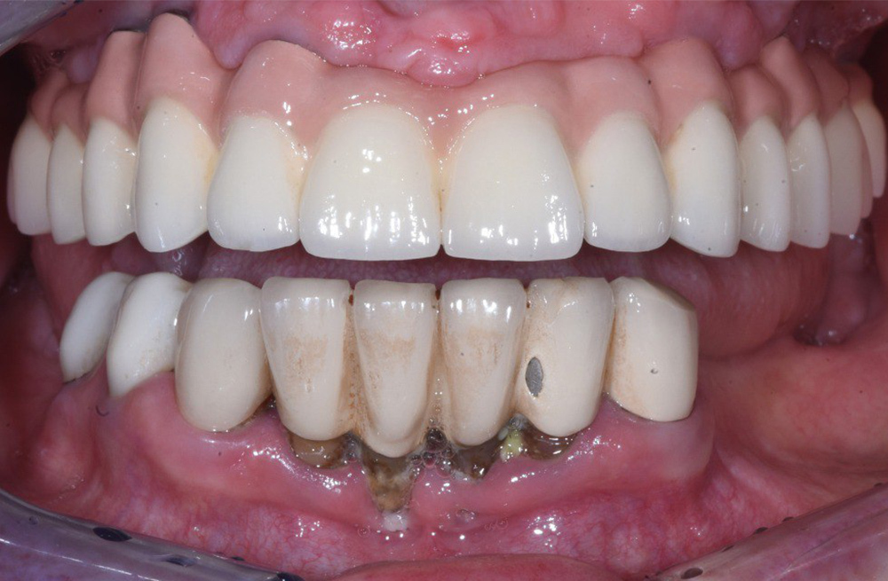 Восстановление зубного ряда с помощью имплантации и временной конструкции