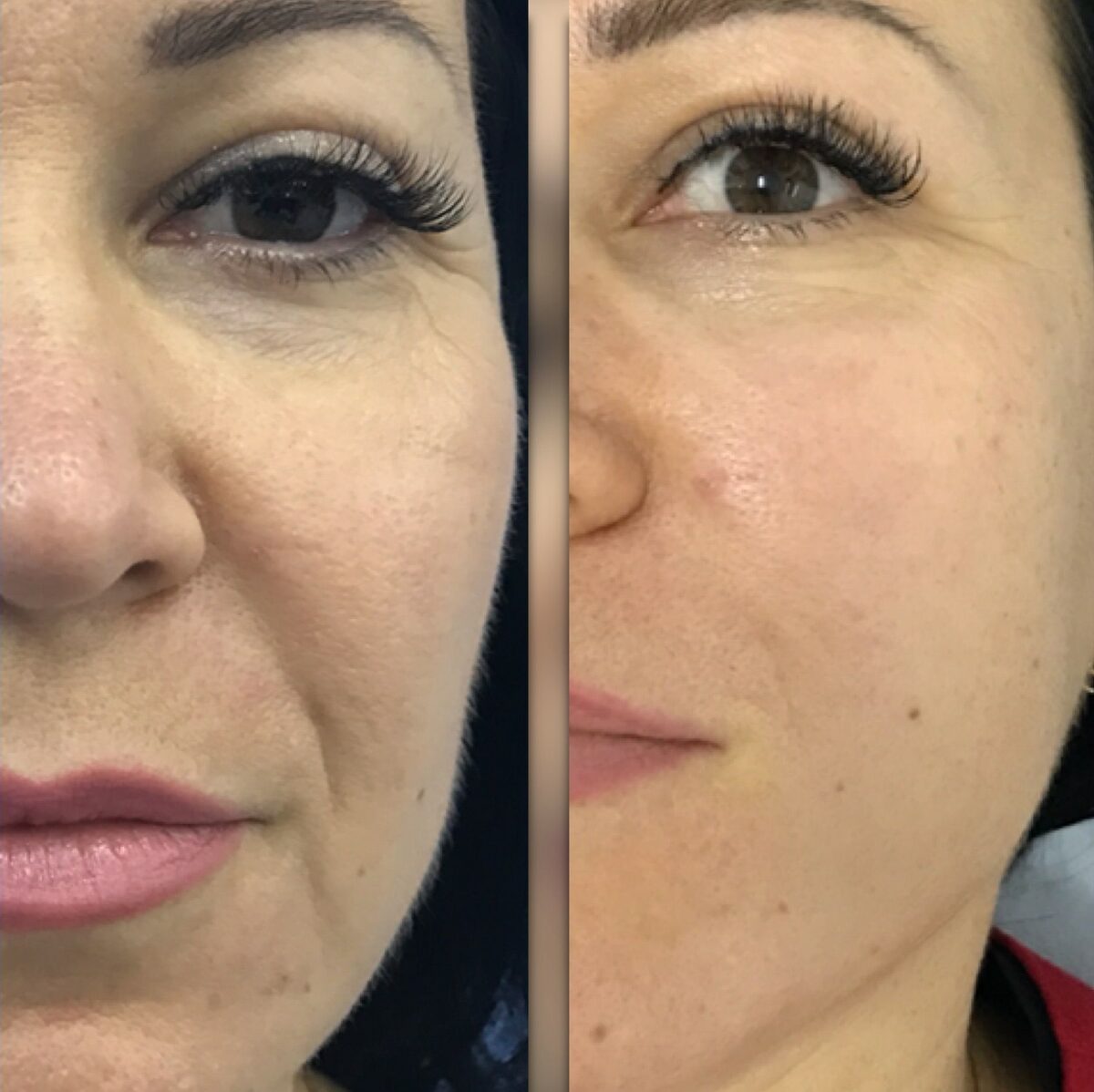 RF Radio Frequency face lifting treatment in Hallandale, Miami, Fort Lauderdale