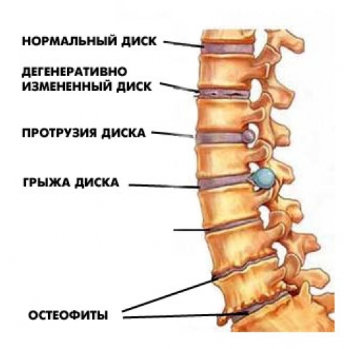 Межпозвоночная грыжа где находится картинки