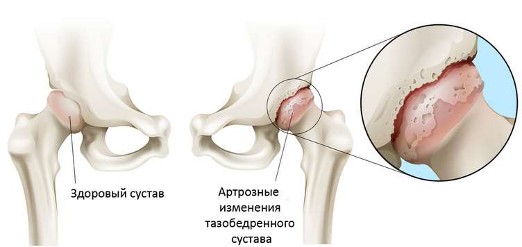 Артроз тазобедренного сустава