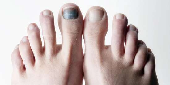 Симптомы, причины и лечение онихолизиса. Тактика при отслоении ногтя