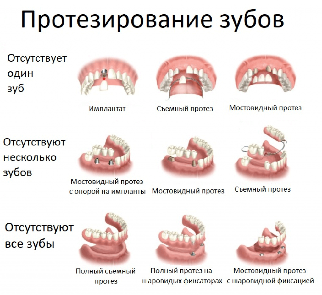 Виды съемных конструкций зубных протезов