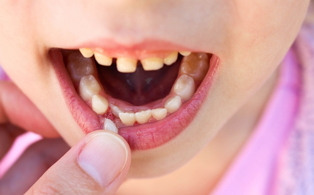 Почему не растут молочные зубы у ребенка? Выпал зуб, новый не растет.