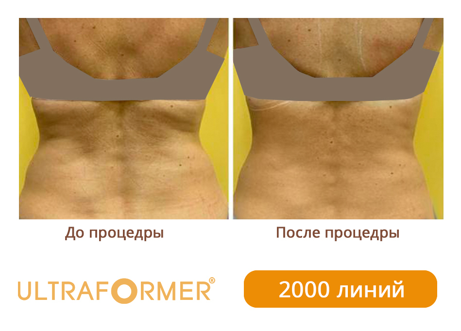 Ультраформер отзывы до и после