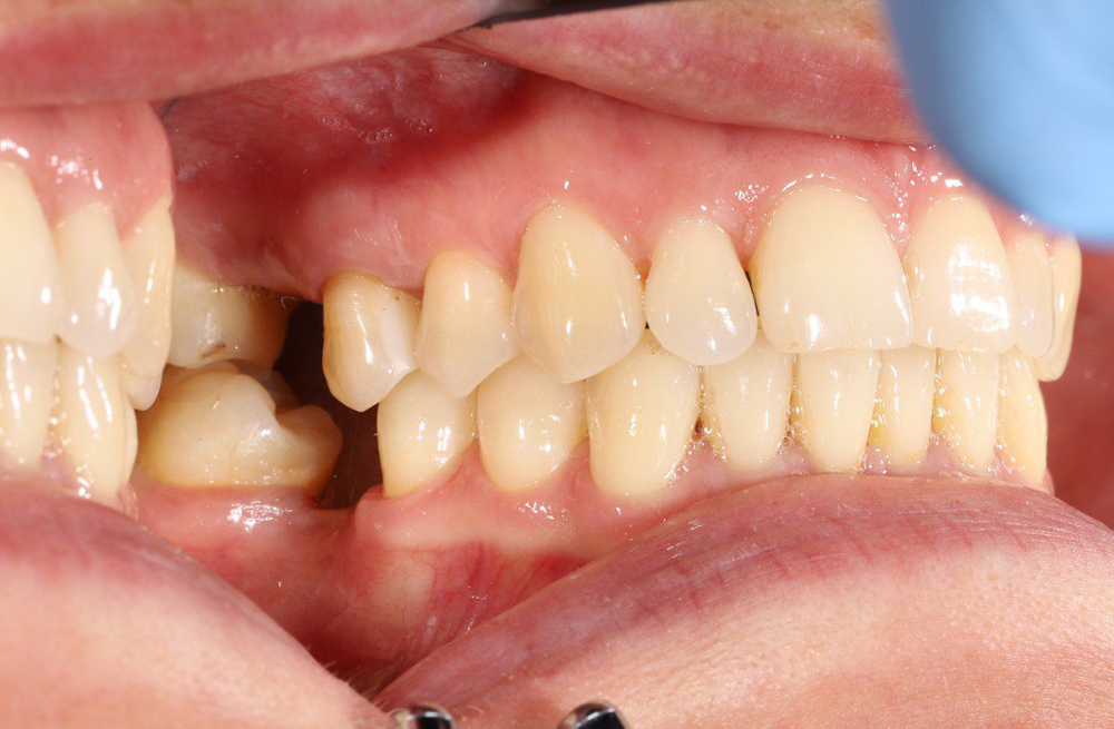 Протезирование коронками с использованием имплантов на месте удаленных зубов