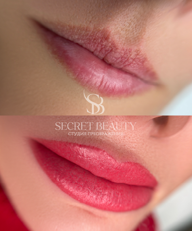 Фото губ до/после