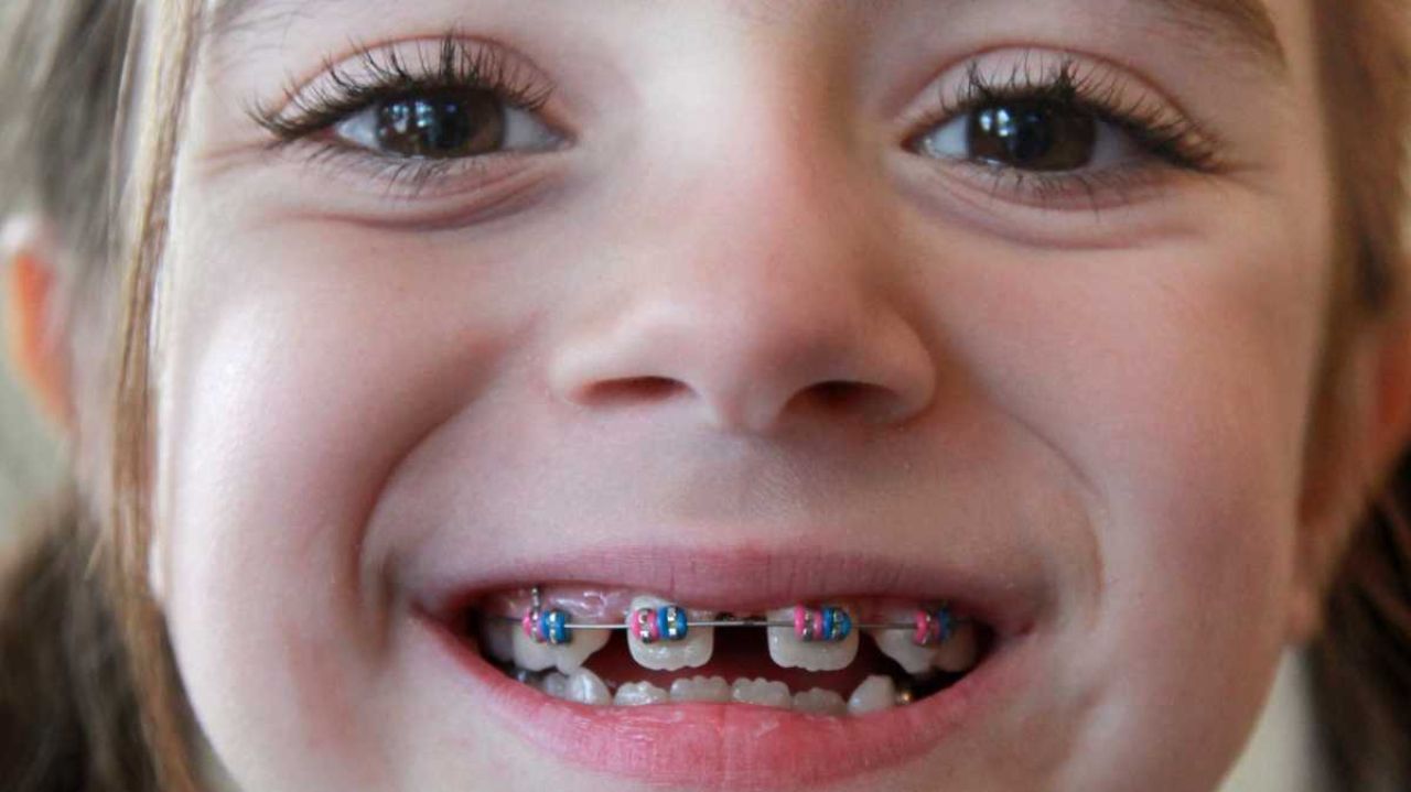 фото кривых детских зубов