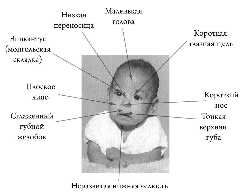 Дети алкоголиков внешние признаки фото