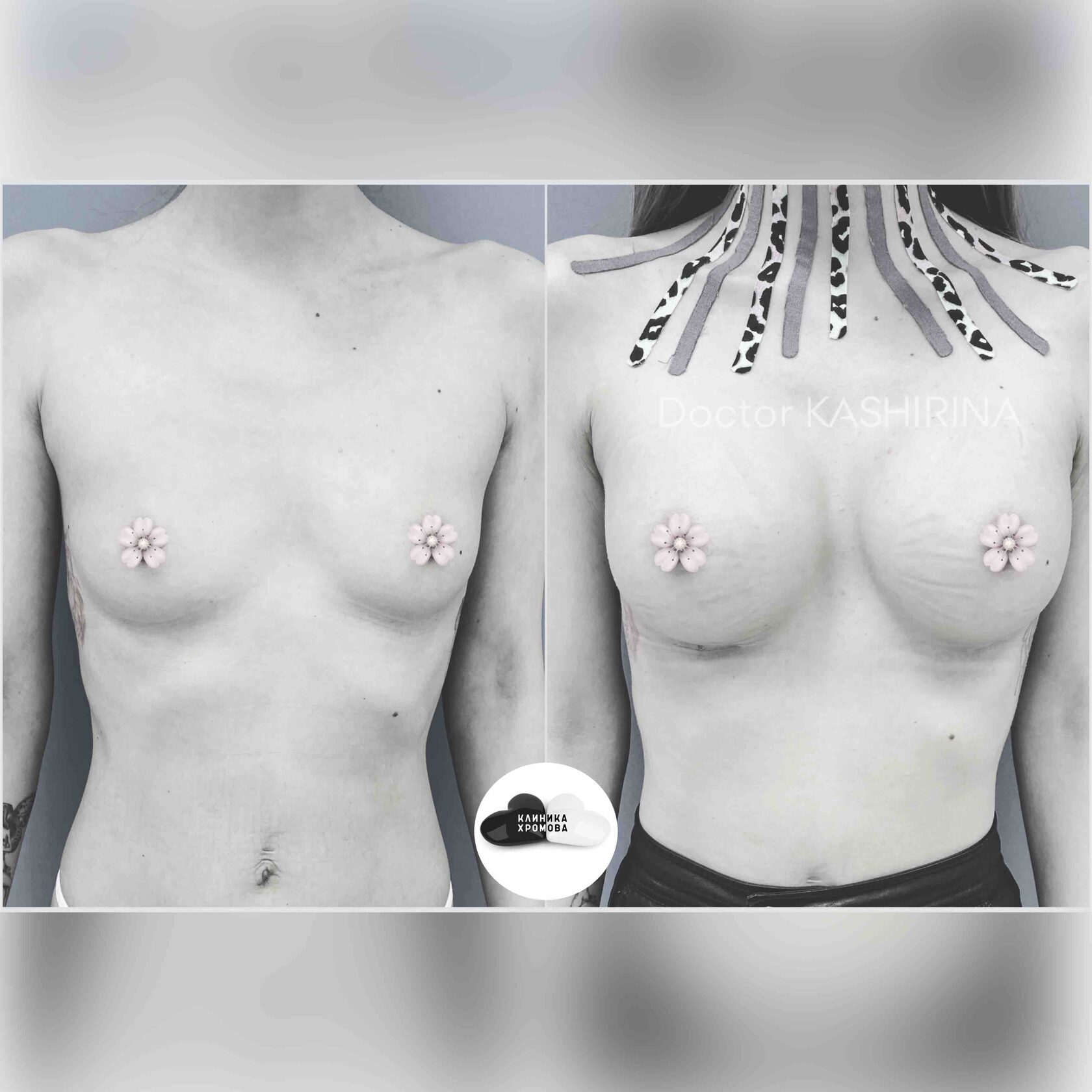 разные импланты на одну грудь фото 25