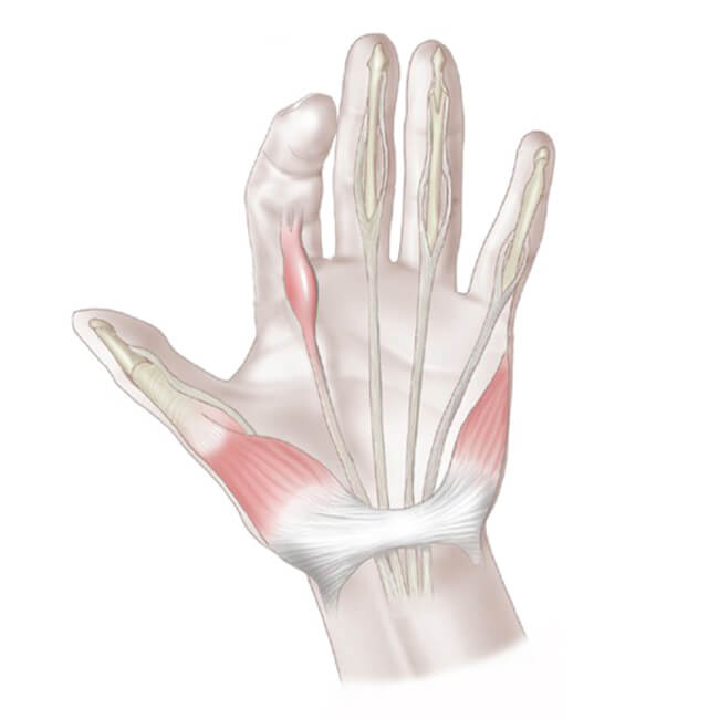 Стенозирующий лигаментит пальца руки. Лигаментит сухожилия сгибателя. Лигаментит сухожилий. Лигаментит сухожилий. Стенозирующий лигаментит нотта.