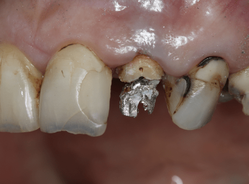 Состояние зубов до установки имплантов и керамических коронок