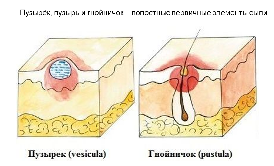 Пузырек первичный морфологический элемент. Первичные элементы сыпи пузырь. Бугорок папула пустула. Первичные морфологические элементы гнойничок.