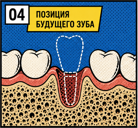 Позиция будущего зуба и импланта