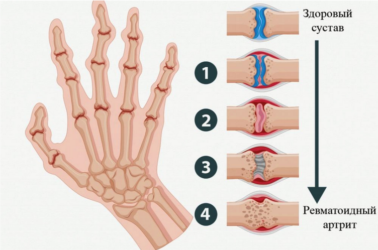 Препараты для лечения артрита пальцев рук