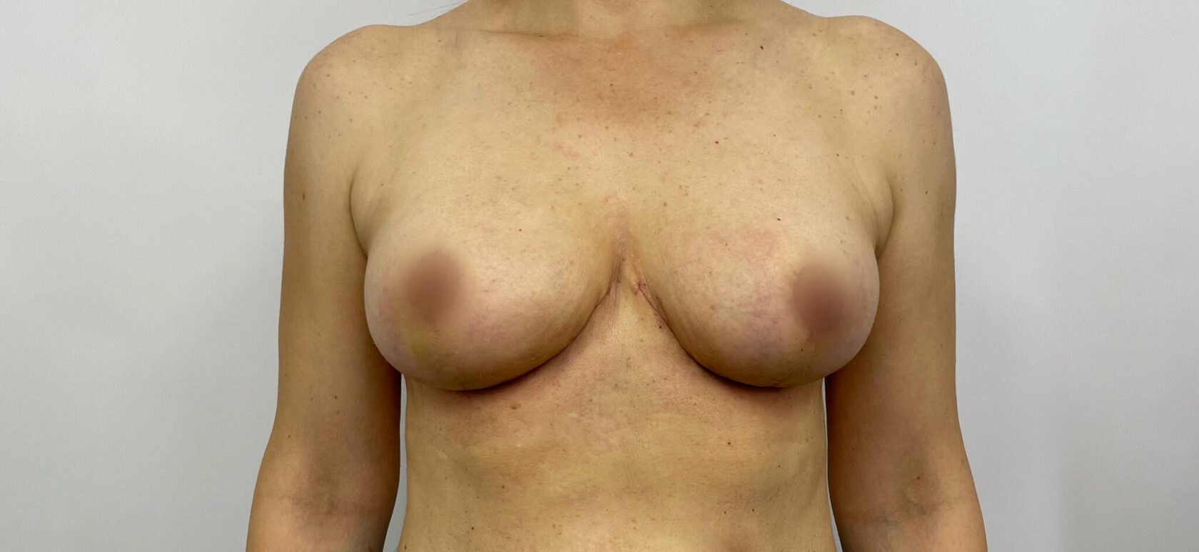 от гормонов увеличилась одна грудь фото 17