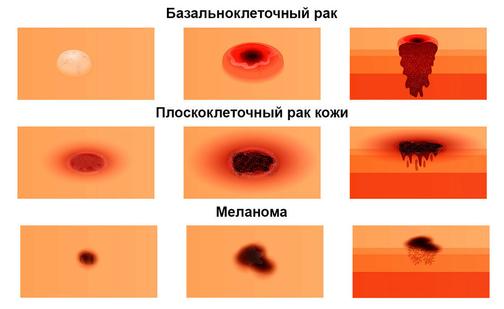 Папилломы на интимных местах - причины, симптомы, диагностика, лечение и профилактика