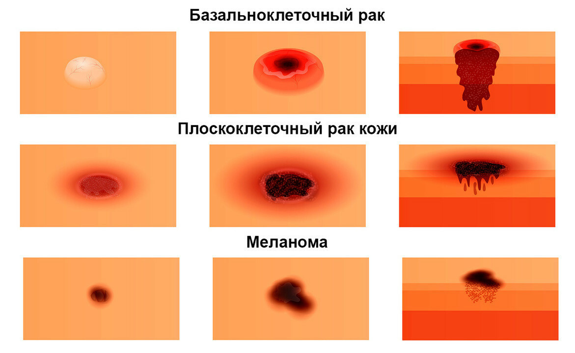 Парафимоз - симптомы, признаки, виды и лечение у мужчин в Москве в «СМ-Клиника»