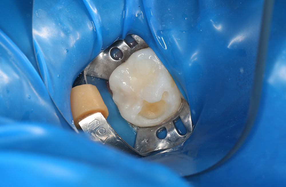 Эстетическая реставрация постоянного зуба при кариесе дентина