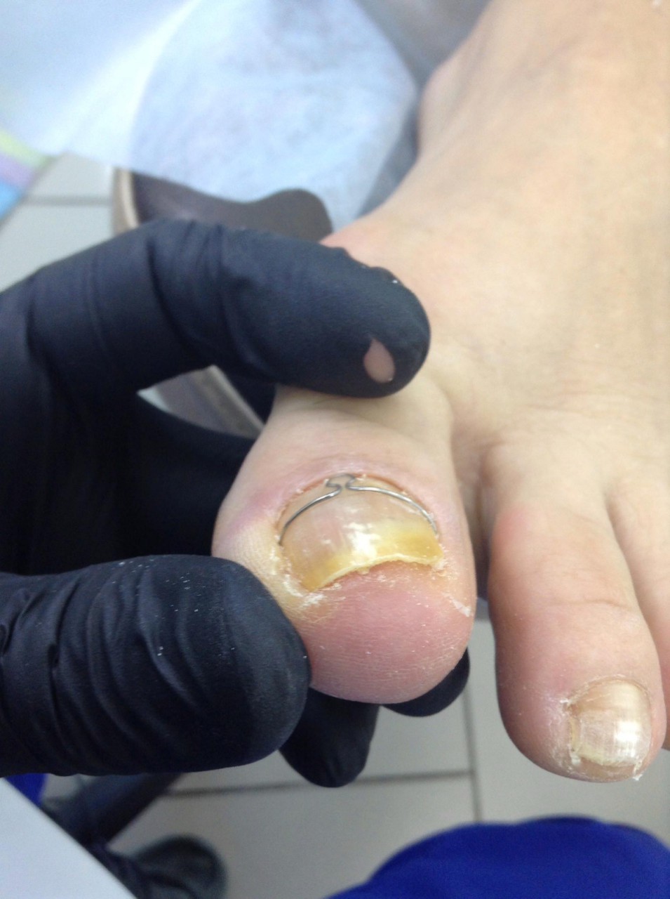 Исправление формы ногтевой пластины