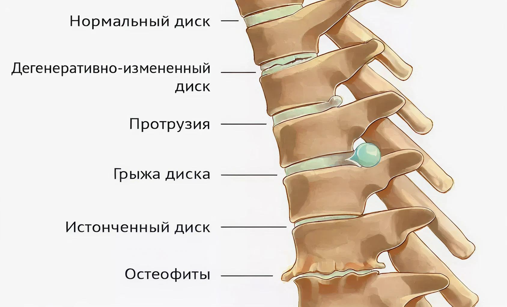 Схема изменений при протрузии