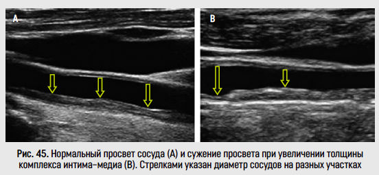 Дуплексное сканирование сонных артерий с определением толщины комплекса интима-медиа в Москве